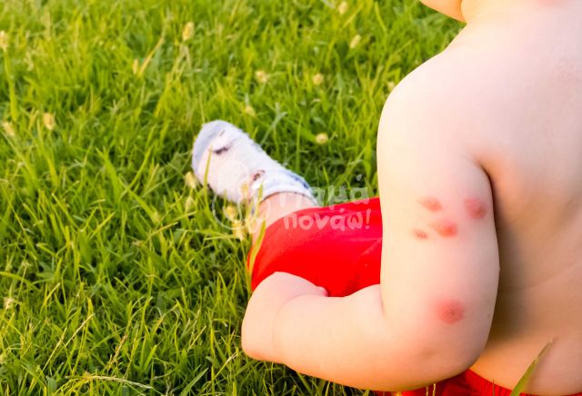 Το Παιδί Μου Είναι Αλλεργικό” – Είναι Στα Αλήθεια ; – Και Αν Ναι, Πως Θα Το Προφυλάξεις ;