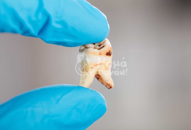 Απώλεια Δοντιών Και Πώς Μπορεί Να Σας Επηρεάσει